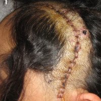 Estudio comparativo de cierre de cuero cabelludo en neurocirugías supratentoriales: intradérmica vs. surget