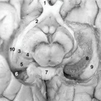 Fig. 6: Techo del asta esfenoidal del ventrículo lateral (vista inferior).