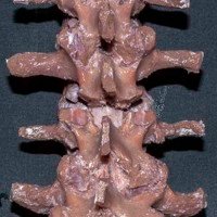 Figura 8: Vista posterior. Osteotomía de Grado 2. Resección completa de ambas facetas en forma bilateral. El canal formado adquiere la forma de una ¨V¨. En el fondo, se observa el saco dural.
