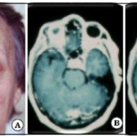 Fig. 1. A. Foto de ingreso de la paciente. B y C. IRM de cerebro con gadolinio.