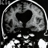 Fig 1. IRM preoperatoria