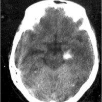 Fig. 1. TAC de ingreso que muestra hematoma temporal izquierdo; colapso parcial de cisternas ambiens y crural (Fisher IV).