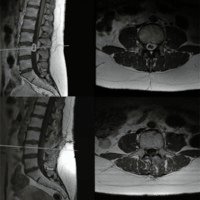 Figura 3: Caso III. Neurinoma IDEM lumbar. En la fila superior se muestra corte sagital de RM secuencia T1 (izquierda) y corte axial (derecha) con lesión tumoral intradural. En la fila inferior se objetiva la resección quirúrgica en cortes de RM sagital (izquierda) y axial secuencia T1(derecha) post contraste. 