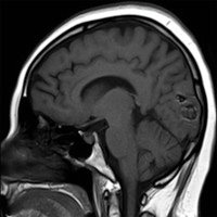 Figura 1: MRI mostrando en secuencia T1 la presencia de una lesión en el lóbulo occipital.