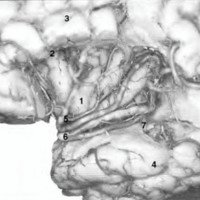 Fig. 9: Arteria cerebral media izquierda con resección de opérculos frontal y temporal. 1, ínsula: 2, surco circular: 3, lóbulo frontal; 4, lóbulo temporal: 5. 1142 (tronco superior): 6, M2 (tronco inferior): 7, M3: 8, M4.
