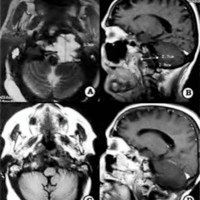 Fig. 1. A y B. IRM en T2 axial y Ti sagital con extensa lesión<br />
anterolateral izquierda con compresión bulbomedular y cerebelosa. C y D. Control postoperatorio.