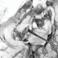 Fig. 8: Arterias coroideas (vista inferior), 1, basilar; 2, cerebral posterior; 3, carótida; 4, coroidea anterior; 5, coroidea pósterolateral; 6, tracto óptico: 7, art, tálamoperforantes.