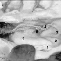 Fig. 5: Piso y borde interno del asta esfenoidal del ventrículo lateral derecho (vista lateral), 