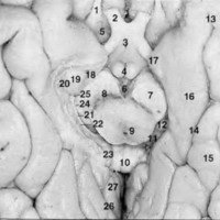 Fig. 4: Cara inferior del cerebro (con resección parcial de la circunvolución parahipocámpica), 