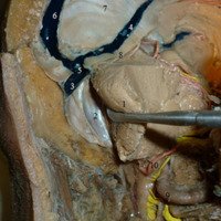 Nuevo Reparo Anatómico para la Identificación del Núcleo Dentado en el Abordaje Suboccipital