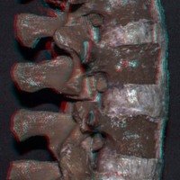 Figura 10: Vista lateral derecha. Osteotomía de Grado 2. Resección completa de ambas facetas articulares. El ligamento amarillo debe ser removido antes del cierre de la osteotomía.<br />
