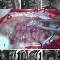 Tumores intramedulares: técnica quirúrgica y presentación de casos ilustrativos