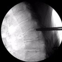 Abordaje transtorácico mínimamente invasivo para la hernia de disco dorsal. Técnica quirúrgica y resultados a corto y mediano plazo<br /><br />
Trabajo a Premio “Dr. Jorge Shilton”. Neurorraquis 2019