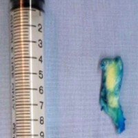 Figura 1: Fragmento extraído mediante discectomía percutánea endoscópica, de 5 cm. de largo, 1 cm. de ancho y 1 cm. de espesor.
