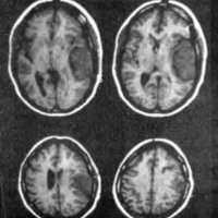 Fig. 1. Meningioma témporoparietal izquierdo.