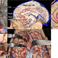Clipado de aneurismas de la arteria cerebral anterior distal: revisión anatómica y presentación de casos