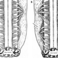 Figura 1: A-B) Esquema que muestra la atípica disposición de las raíces a nivel lumbusacro de los pacientes con disrrafismos como el mielomeningocele. A: del lado derecho se observa las raíces dorsales de L5 y S1. B: anatomosis con injerto entre raíces ventrales de L5 y cabo distal de la raíz ventral de S3 (Gentileza Dr. Xiao).