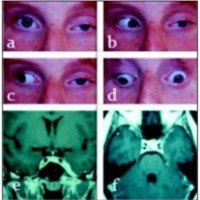 Fig. 1. a ,b, c, y d. Oftalmoplejía de ojo izquierdo. e, f. IRM de encéfalo: hiperintensidad del seno cavernoso izquierdo con aumento de su tamaño.