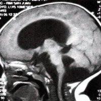 Fig. 1. IRM de cerebro, T1 sin contraste, corte sagital donde se observa la gran dilatación ventricular con agenesia del vermis y quiste retrocerebeloso.