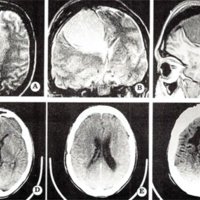 Fig. 1.A, B y C. IRM. Se observa meningioma gigante parasagital, con herniación subfaiciforme y signos de hiperostosis. D, E y F. TAC postoperatoria sin remanente tumoral. Exeresis total Simpson 2