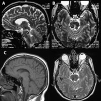 Figura 1: a) y b) RNM de cerebro cuando presentó la sintomatología neurológica; c) y d) RNM 20 años después con examen absolutamente normal.