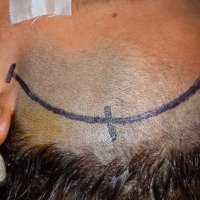 Abordaje pterional: alcances y revisión de la técnica quirúrgica