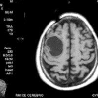 Fig. 1. IRM con contraste: tumor quístico en área central.