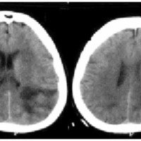 Fig. 1. TAC de encéfalo que muestra lesión espontáneamente hiperdensa parainsular derecha y otra lesión hipodensa parietooccipital izquierda, heterogénea, de bordes mal definidos.
