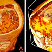 Figura 1 A y B: Reconstrucción 3D de IRM. Se observa meningioma de la convexidad parasagital en área premotora izquierda y su relación con los giros, surcos y estructuras venosas corticales.