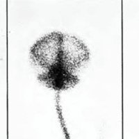 Fig. 7. Caso 4. Cisternografia radioisotópica (24 hs).