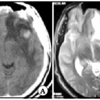 Fig. 1. TAC (A) e IRM (B) con diagnóstico presuntivo de tumor cerebral.