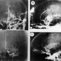 Figura 1. Caso N° 17 M. C. En ambas fotos superiores (A) y (B). se ve la M.A.V. en la angiografía preirradiación. En las de abajo (C) frente y (D) perfil muestran obliteración total de la M.A.V. 24 meses después. Ej. caso de Grupo I.