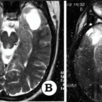 Fig. 1. Clasificación de los pacientes mediante IRM preoperatoria. A. mesial; B. neocortical; C.mixto y D. temporal plus.