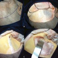 Tratamiento Quirúrgico de los Meningiomas del Foramen Óptico:<br /><br />
Técnica y Resultados de una Serie de 18 Pacientes