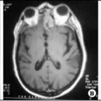 Estesioneuroblastoma y panhipopituitarismo: presentación de un caso