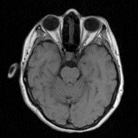 Figura 1: RMI cerebral, axial T1 realizada semanas previas a la internación donde se observa la ausencia de proceso expansivo.