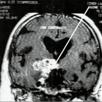 Fig. 1. Granuloma micótico temporal derecho, la línea blanca muestra el trayecto del venlriculoscopio