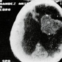 Figura 1. TAC que muestra voluminoso proceso ocupante del ventrículo lateral derecho con hidrocefalia.