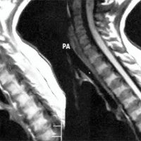 Fig. 10. Caso 5. IRM sagital prequirúrgica, Invaginación basilar. Orificio magno estrecho. Borramiento del espacio subaracnoideo espinal.