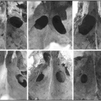 Anatomía microquirúrgica de los Ostia esfenoidales